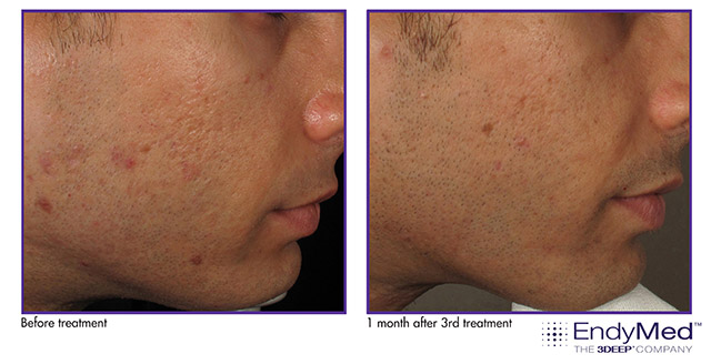 EndyMed Intensif Acne Scar Therapy before and after photos