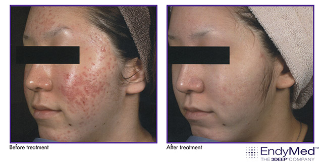 EndyMed Intensif Acne Scar Therapy before and after photos