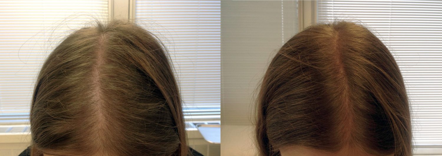 Platelet-Rich Plasma (PRP) for Hair Loss, Before and After