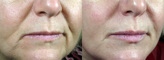 Combination Treatment: ProFractional, Thermage and Juvederm, Before and After Silkpeel Dermalinfusion: Hyperpigmentation, Before and After Selphyl (PRP): Tear trough, Before and After 3 & 6 Months Two treatments, six weeks apart
