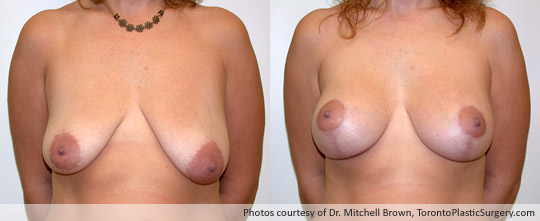 Breast Augmentation and Lift, Before and After 6 Months