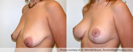 Breast Augmentation and Lift, Before and After 6 Months