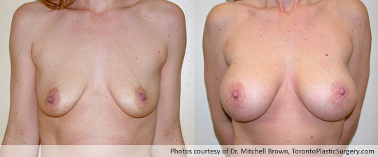 Breast Augmentation and Lift, Before and After 6 Years