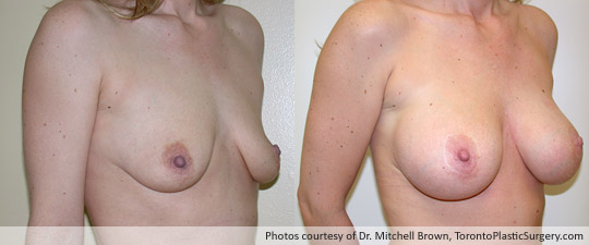 Breast Augmentation and Lift, Before and After 6 Years