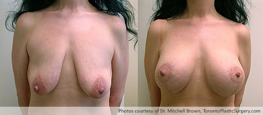 Breast Augmentation and Lift: Breast Lift and 397gm Smooth Round Gel Implant, Before and After 6 Months