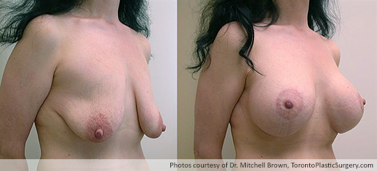 Breast Augmentation and Lift: Breast Lift and 397gm Smooth Round Gel Implant, Before and After 6 Months