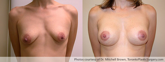 Breast Augmentation and Lift: Breast Lift and Shaped Gel Implant – 295gm on the left, 280 gm on the right, Before and After 6 Months