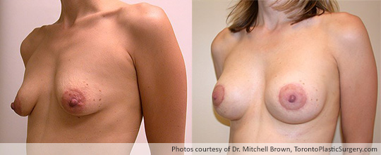 Breast Augmentation and Lift: Breast Lift and Shaped Gel Implant – 295gm on the left, 280 gm on the right, Before and After 6 Months
