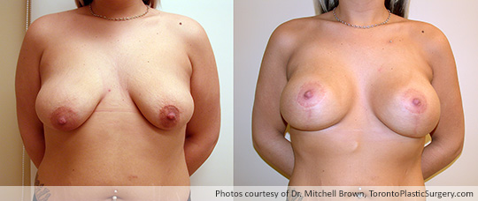 Breast Lift with Round Gel Implants, Before and After 6 Months