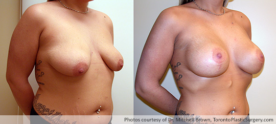 Breast Lift with Round Gel Implants, Before and After 6 Months