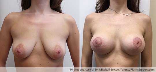 34-year old patient with 295gm Round Gel Implants under muscle and breast lift, Before and After 3 Months