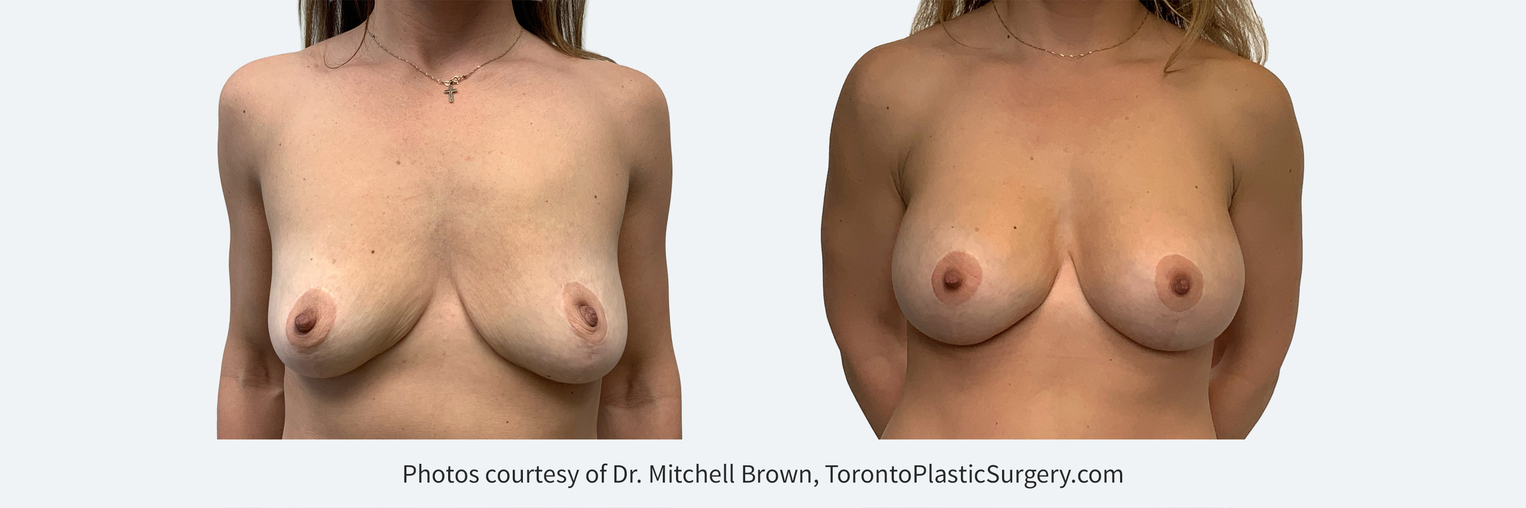 Previous breast reduction, lost weight and now desires implants. Before and 6 month after augmentation with 425cc implants.