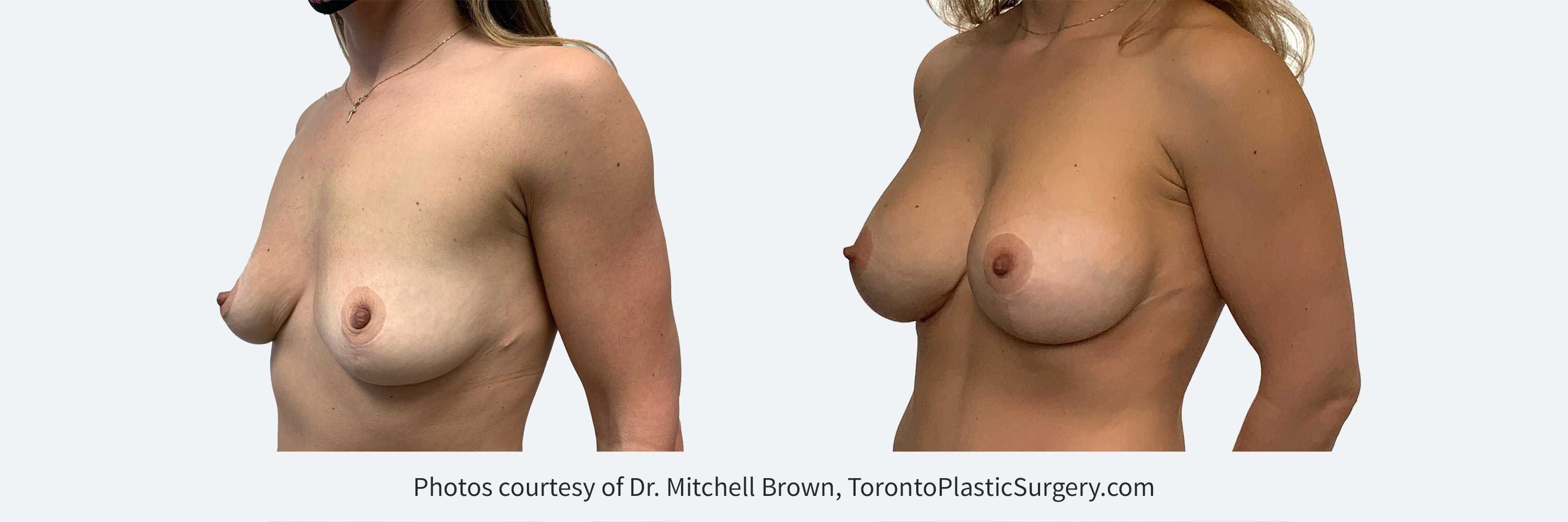 Previous breast reduction, lost weight and now desires implants. Before and 6 month after augmentation with 425cc implants.