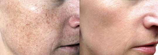 Fractional CO2 Laser in Toronto