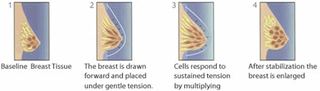 Breast Augmentation with Fat Transfer (AFT) – Toronto Plastic Surgery