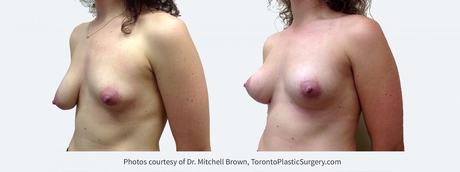 Breast asymmetry with smaller left breast. Treated with left breast augmentation with fat grafting and right breast lift. Before and 6 months after