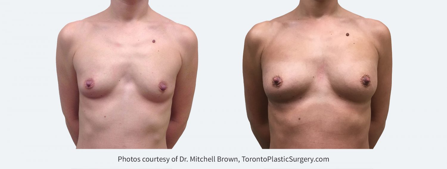 Breast augmentation performed with fat grafting. Single session of 345cc of fat on each side. Before and 6 months after.