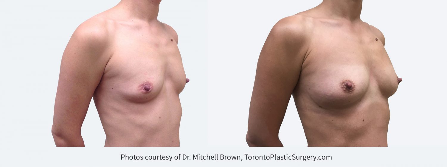 Breast augmentation performed with fat grafting. Single session of 345cc of fat on each side. Before and 6 months after.