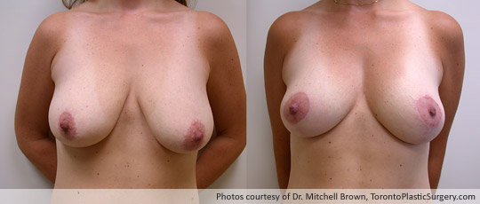 Breast Lift, Before and After 6 Months