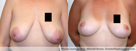 Breast Lift, Before and After 8 Months