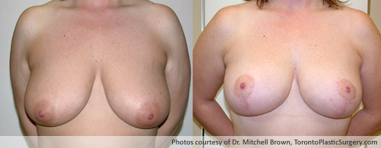 Breast Lift, Before and After 6 Months