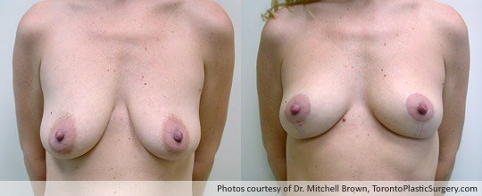 Breast Lift, Before and After 10 Months