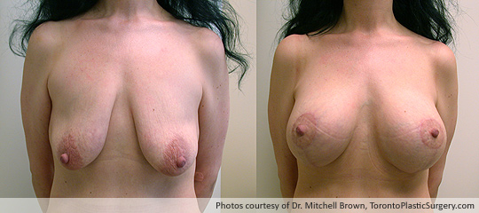 Breast Lift, Before and After 6 Months