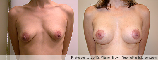 Breast Lift/Augmentation with Shaped Gel Implants, Before and After 6 Months