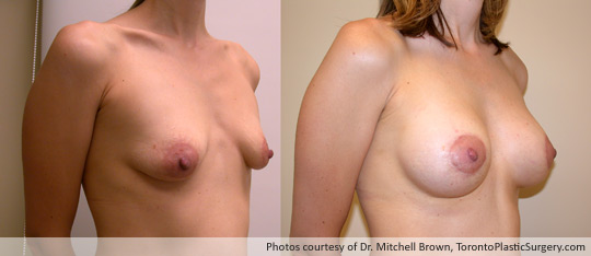 Breast Lift/Augmentation with Shaped Gel Implants, Before and After 6 Months