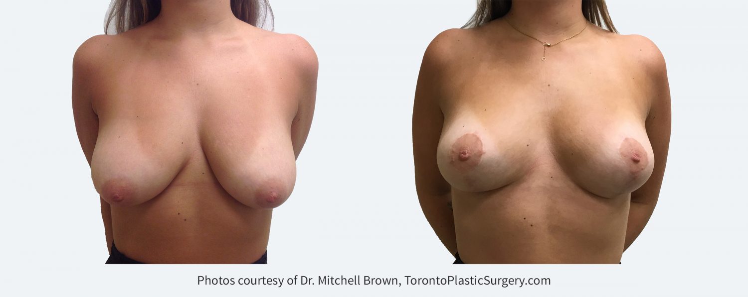 Breast Lift, Before and After 6 months