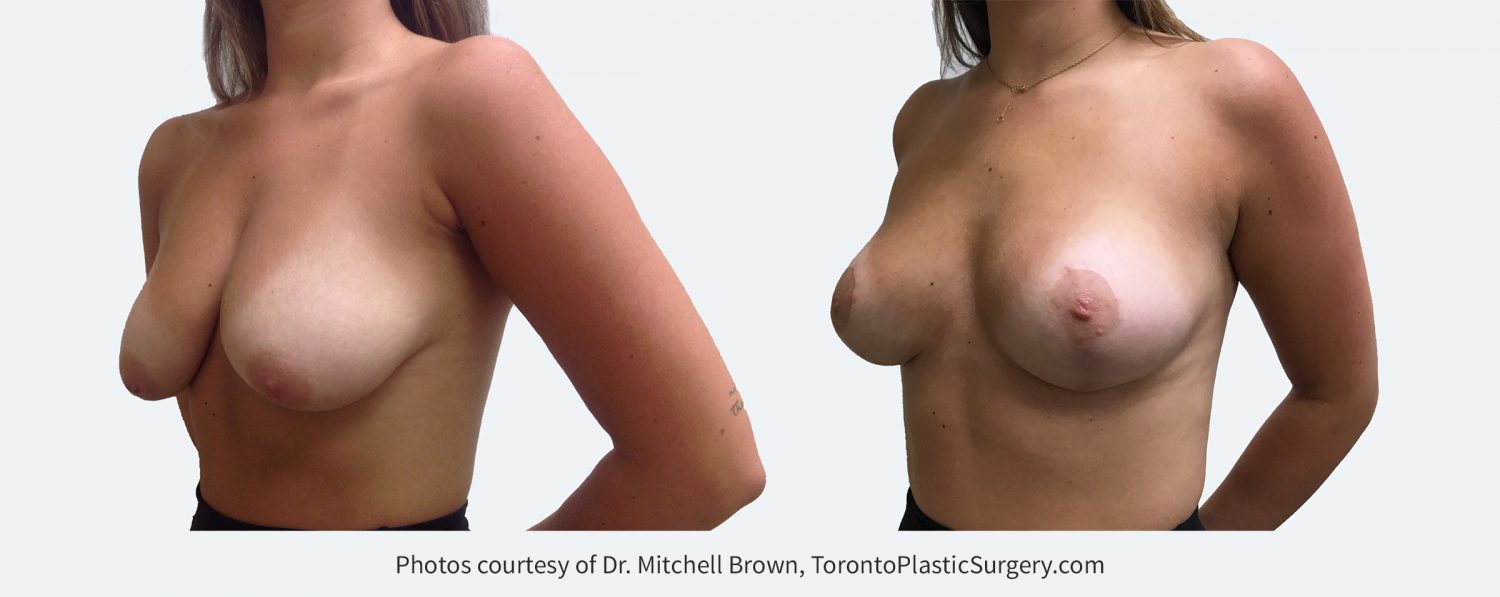 Breast Lift, Before and After 6 months