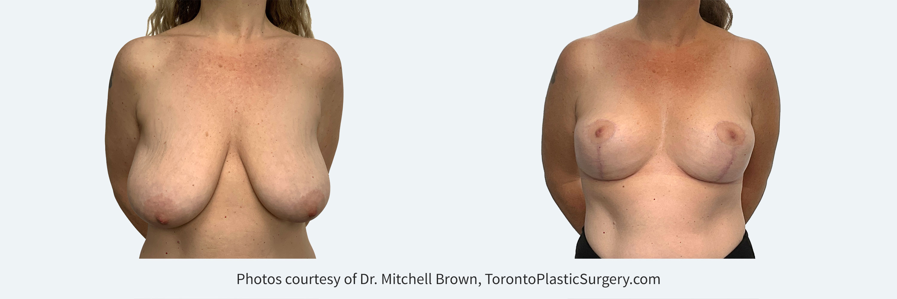 Breast Lift, Before and After 6 Months