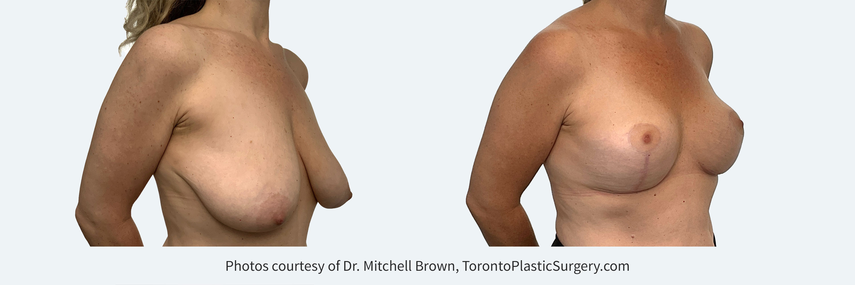 Breast Lift, Before and After 6 Months