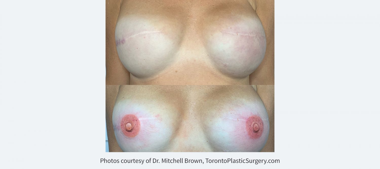 3D tattoo of nipple and areola following implant breast reconstruction