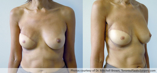 Right Breast Reconstruction, Latissimus Muscle Flap and Implant