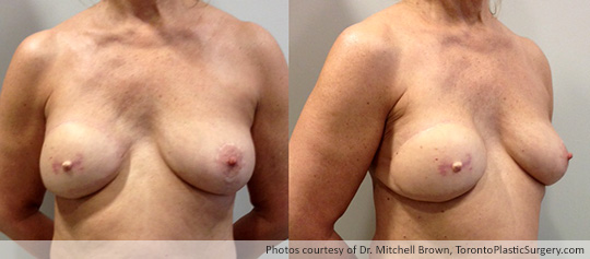 Right Latissimus Flap from Back with Implant, Nipple Reconstruction Prior to Tattoo