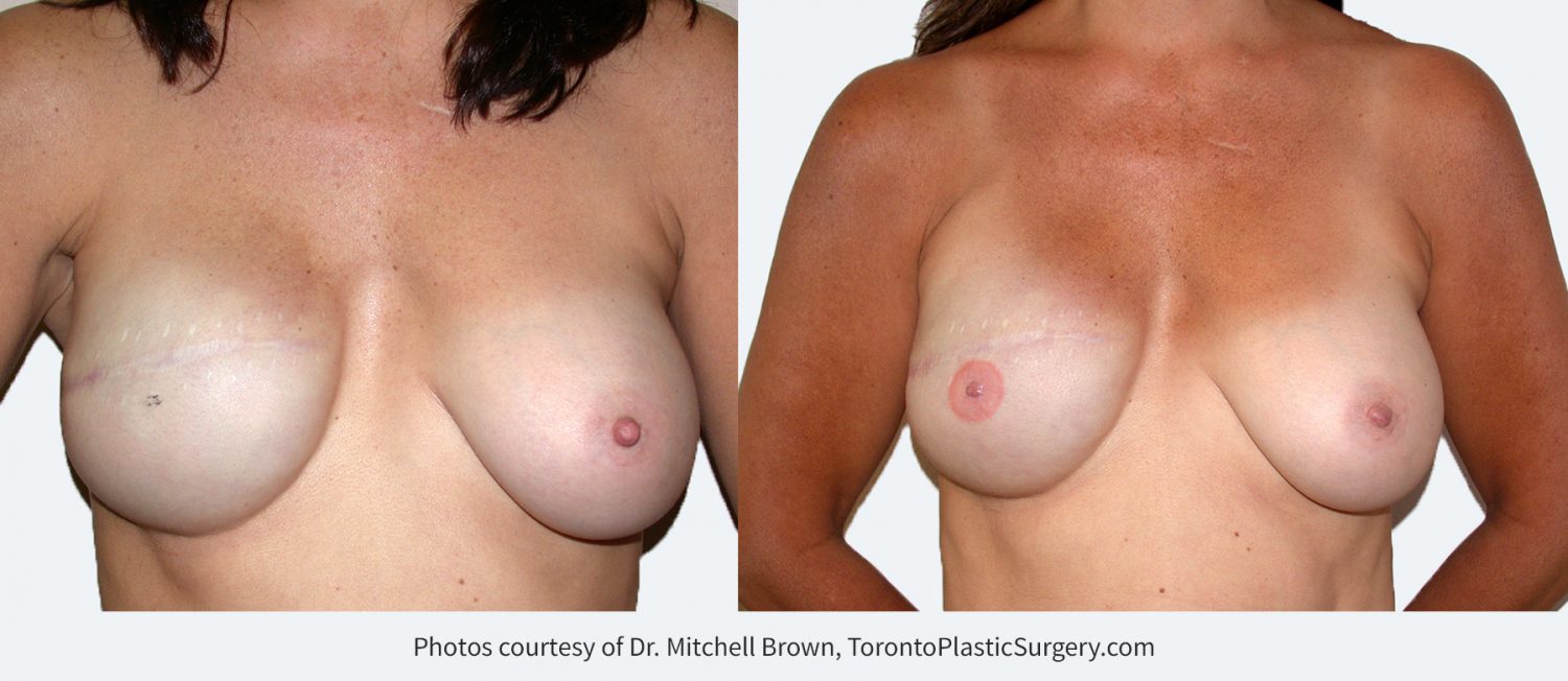 Right Breast Reconstruction with Implant Before and After Nipple Reconstruction