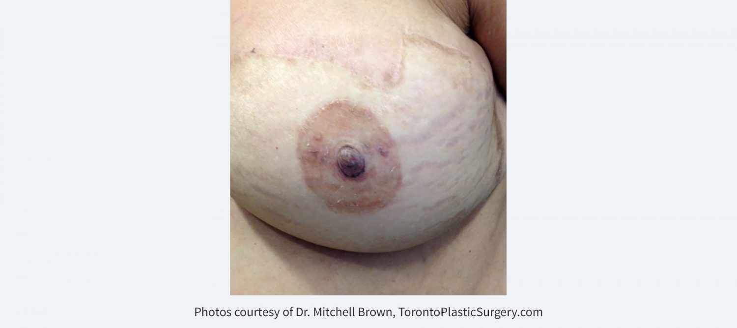 Nipple Reconstruction with 3D Tattoo