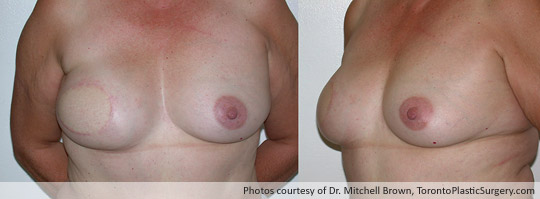 Breast Reconstruction, TRAM Flap Right Breast Before Nipple Reconstruction