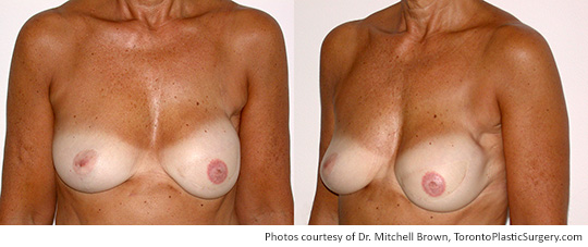 Left TRAM Flap and Right Breast Lift, Before and After 1 Year