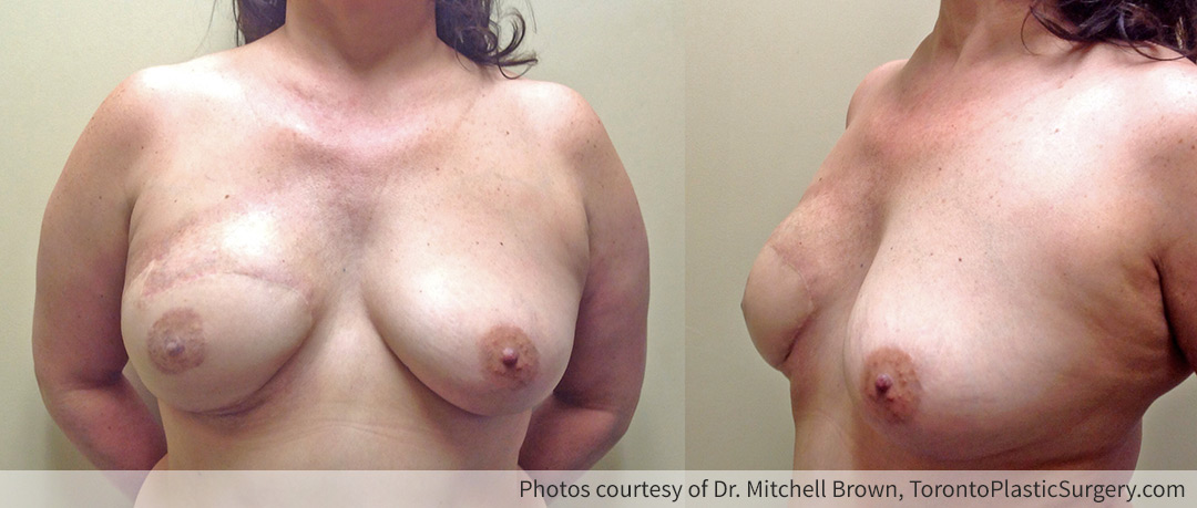 Right TRAM Flap, 1 year following breast and nipple reconstruction