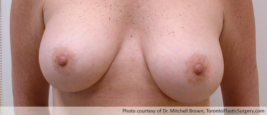 Requires Left Mastectomy Due to Breast Cancer