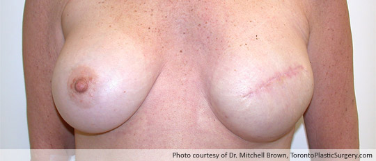 Breast Reconstruction, 400gm Round Gel Implant and Alloderm