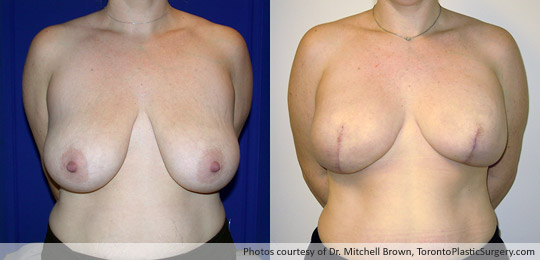 Bilateral Mastectomy for Breast Cancer, Breast Reconstruction Using 500gm Round Gel Implants