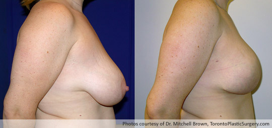 Bilateral Mastectomy for Breast Cancer, Breast Reconstruction Using 500gm Round Gel Implants