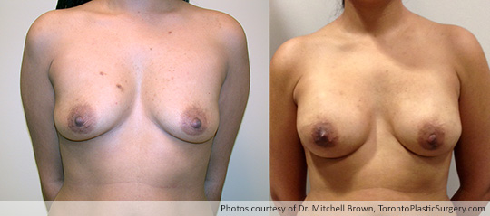 Bilateral Nipple-Sparing Mastectomy, Reconstruction with 375gm Implant and Alloderm, Before and After 1 Year