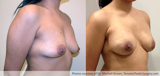 Bilateral Nipple-Sparing Mastectomy, Reconstruction with 375gm Implant and Alloderm, Before and After 1 Year