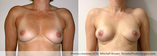 Bilateral Nipple-Sparing Mastectomy