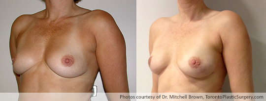 Bilateral Nipple-Sparing Mastectomy