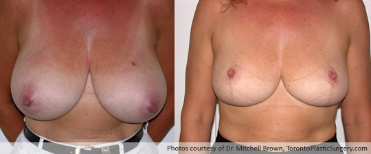 Breast Reduction, Before and After 6 Months